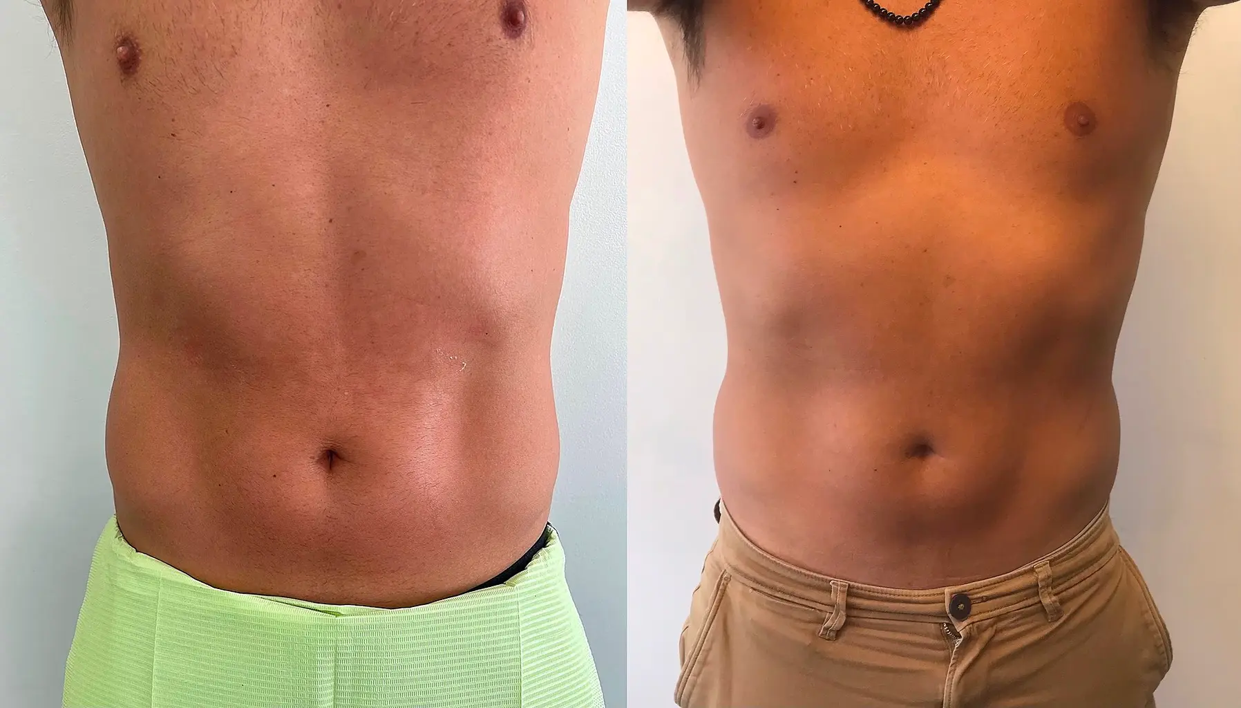 Tratamiento Biosculpt - Bioestimulación